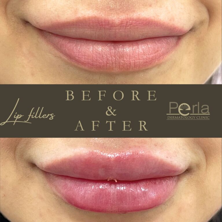 Lips Filler 1