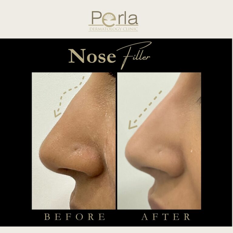 Nose Filler 2