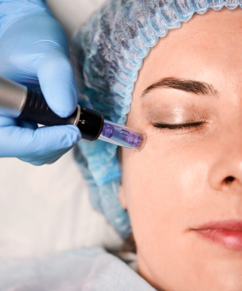 Close up of cosmetologist hand in sterile glove using dermapen during skincare procedure. Young woman receiving facial treatment at wellness center. Concept of beauty, skincare, anti-aging procedure.